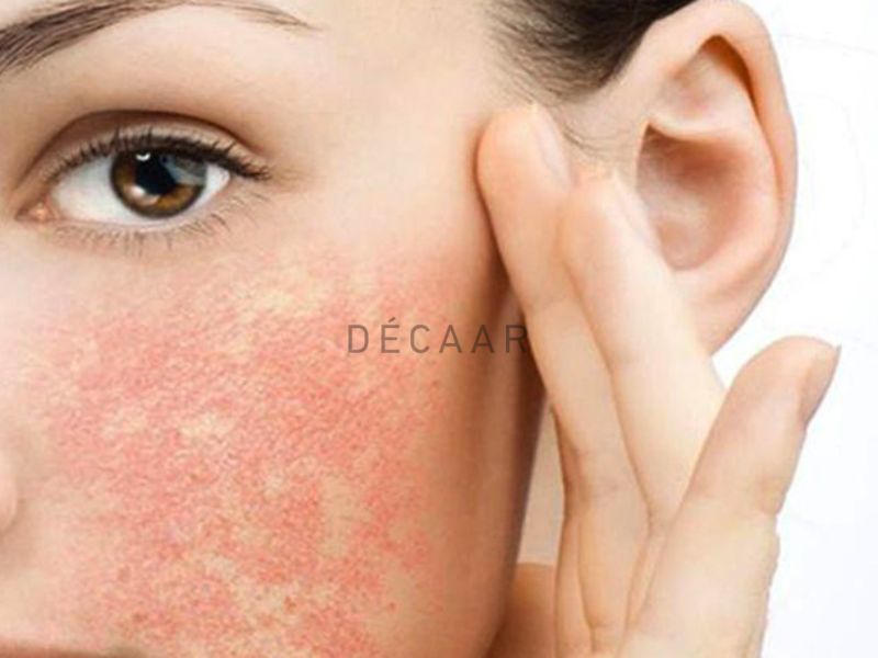 da nhiễm corticoid có nên lăn kim